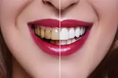 الآثار الجانبية المحتملة لتبييض الأسنان- تعرف عليها 