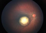 يهدد الأطفال- 5 أعراض لورم الشبكية