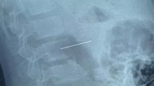 استخراج مسمار دباسة من بطن طفل