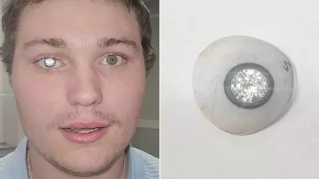 عين اصطناعية