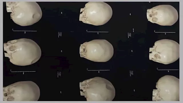 صورة أشعة الجمجمة