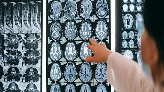 دراسة: مزيج مكملات غذائية يحقق نتائج واعدة ضد أخطر