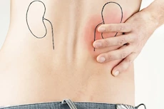 طبيب: هذا أفضل مشروب لمرضى الكلى بعد الإفطار في رمضان