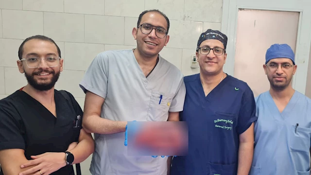 استئصال طحال بوزن 2 كيلوجرام