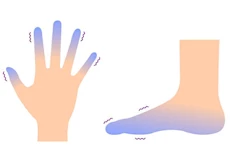 احذر- برودة الأطراف في الصيف عرض لهذه الأمراض