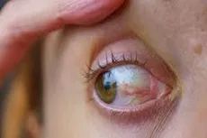 احذر- طبيب يوضح أمراض مزمنة تؤثر على العين