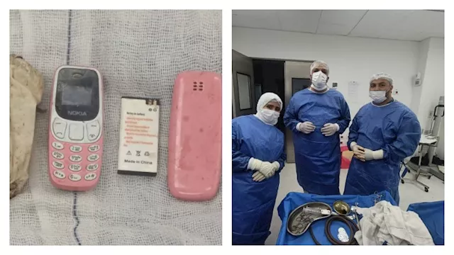 ‬استخراج موبايل من معدة مريض في عملية نادرة بالقلي