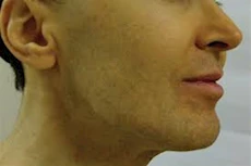 لمرضى الصفراء- أطعمة ممنوع تناولها