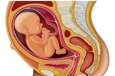 الطفل المقعدي خلال الحمل.. تعرف على الأسباب والعلاج