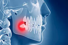 هل يجب خلع ضرس العقل دائمًا؟ طبيب يُجيب