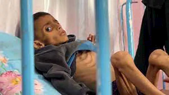 ''التجويع'': مأساة صامتة تفتك بالجسد.. فما الذي يع