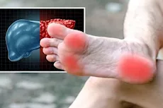 انتبه لقدميك- 6 أعراض لمرض الكبد الدهني تظهر عليهما