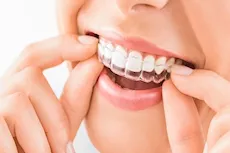 مميزات وعيوب التقويم الشفاف.. تعرف عليها