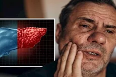 تظهر في الفم- 3 أعراض لمرض الكبد الدهني احذرها