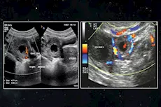 امرأة تحمل في الكبد بدلًا من الرحم.. هل سمعت بذلك من قبل؟| التفاصيل
