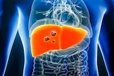 كبدك في خطر- إهمال علاج هذا المرض يصيبه بالأورام