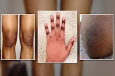 كيف تتخلصين من سواد المفاصل بطرق بسيطة وآمنة؟