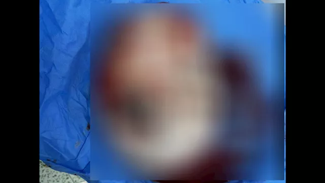 استئصال ورم مبيضي بوزن 7 كجم