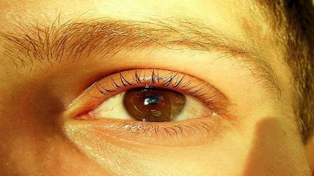 اصفرار الجلد