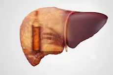 رغم تجنب الكحوليات- 9 أسباب للإصابة بمرض الكبد الدهني