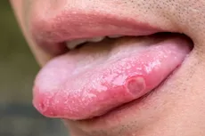 تكشف عن فيروس خطير- 6 أعراض تظهر في الفم احذرها