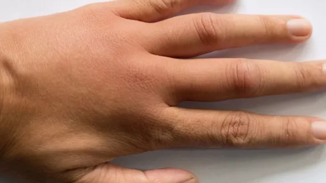 أعراض أمراض الكبد على الأصابع