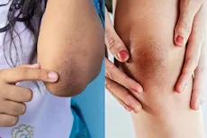 وداعًا لاسمرار الكوع والركبة- 8 وصفات لتبييضهما