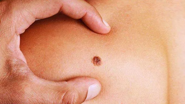 فيروس الورم الحليمي البشري