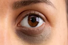 علاج الهالات السوداء بأكياس الشاي.. هل هذا ممكن؟