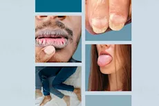 تظهر على الجلد- 6 أعراض لنقص الحديد احذرها