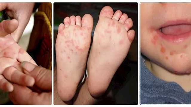مرض اليد والقدم والفم
