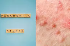 تظهر على الجلد- 6 أعراض لأورام البنكرياس احذرها