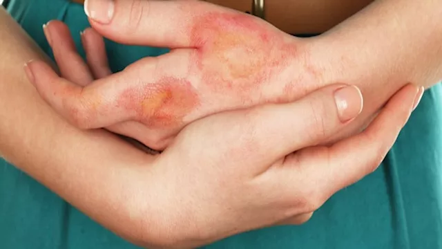 ترند الحروق