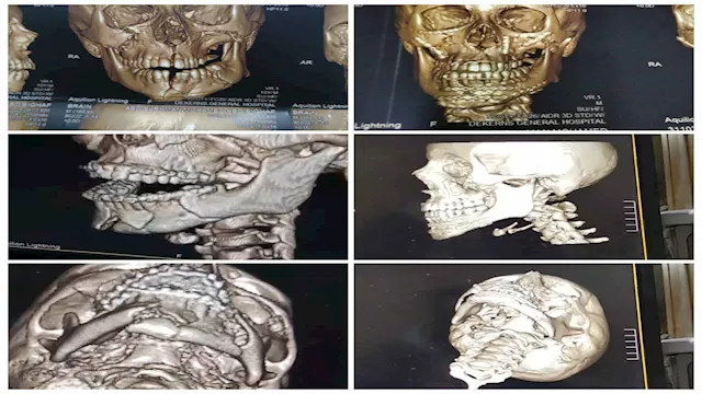فريق طبي بمستشفى دكرنس العام ينقذ طفلًا من تهشم كا