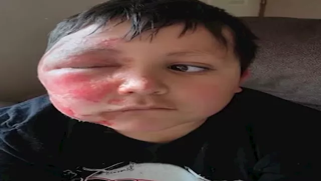 "تحدي تيك توك" يتحول لكارثة.. طفل يصاب بحروق خطيرة