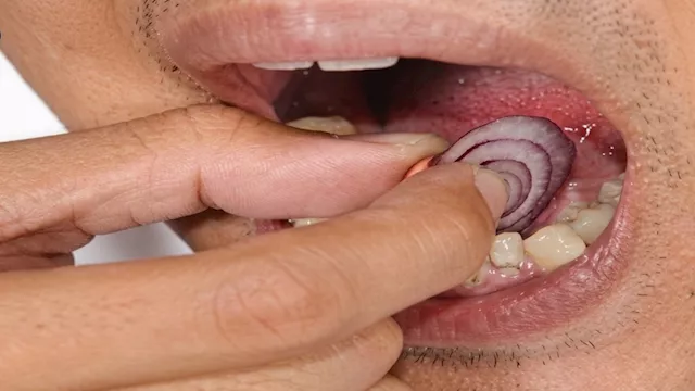 نقابة أطباء الأسنان بالبحيرة تحذر من استخدام البصل