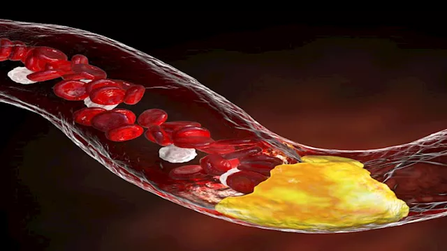 الكوليسترول