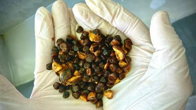 حصى المرارة