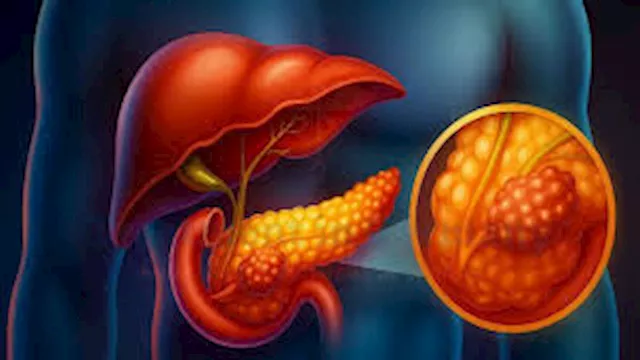 السرطان في البنكرياس