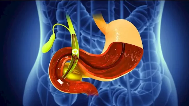 صحة المرارة في رمضان