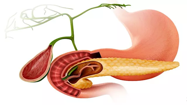 حصوات المرارة