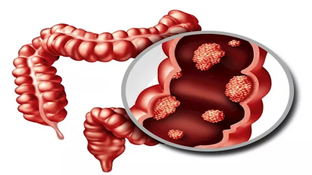 سرطان الأمعاء