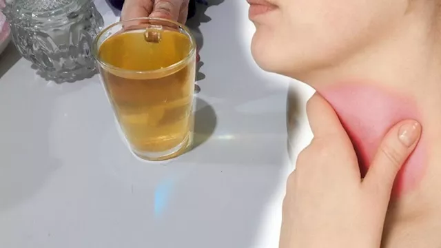 التهاب الحلق