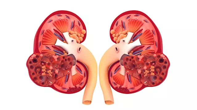 الفشل الكلوي