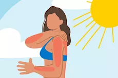  علاج حروق الشمس بالمنزل- 8 طرق طبيعية تخلصك منها      