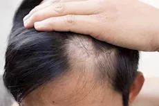 هل زراعة الشعر لعلاج مرض الثعلبة فعال؟- إليكِ الحقيقة