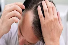 لا يمكن علاجه بالزيوت.. 5 علامات لتساقط الشعر الوراثي 