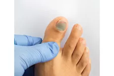 الظفر الأسود في فصل الصيف.. إليك الأسباب وطرق العلاج