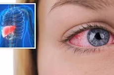 أعراض الكبد في العين- 5 علامات تظهر فيها تدل على تليفه  