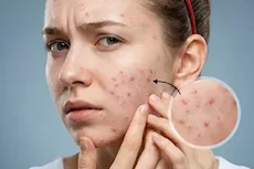 هل ماء القرنفل يمكن أن يعالج حب الشباب؟- إليك حقيقة الأمر